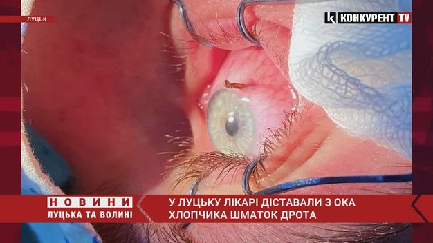 Дріт з батога застряг в оці хлопчика, його врятували луцькі медики (фото, відео 18+)