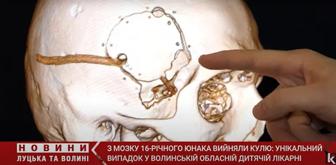 Куля пройшла повз важливі ділянки: як у Луцьку оперували пораненого в голову юнака (відео)