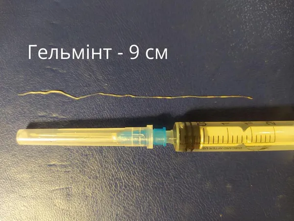 У волинянки дістали з ока чималого глиста (фото)